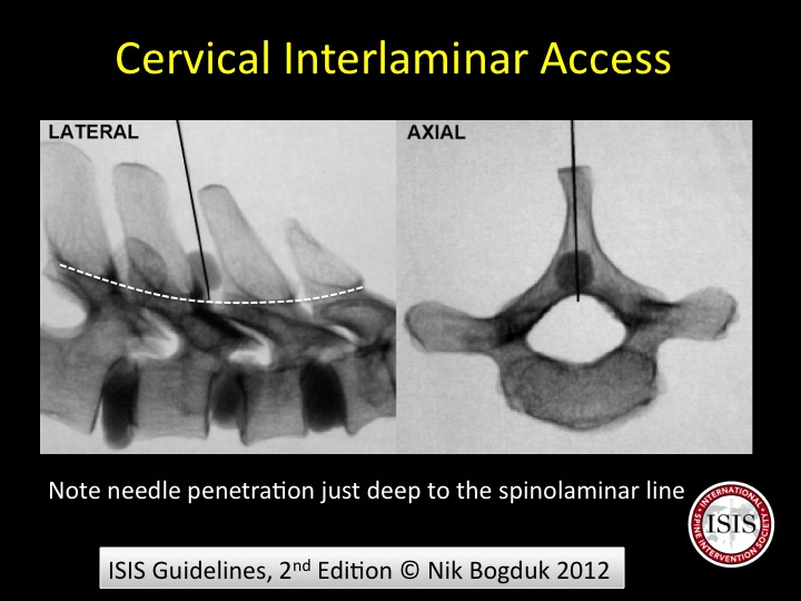 will emg nerve test still work if on steriod for pain